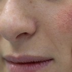 PROBLEMAS VASCULARES EN EL ROSTRO, con Helga Rivera