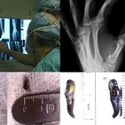 Implantes Alien. Quizás Tengas Uno y No lo Sabes