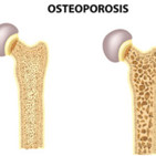 Episodio 23. ¿Por qué la osteoporosis no se resuelve sólo tomando lácteos?
