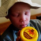 Albinismo: desde el Kilimanjaro hasta al CRISPR