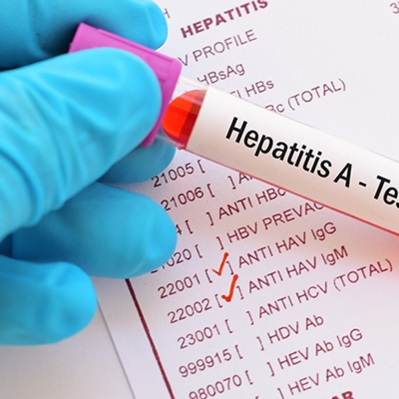 Advierten sobre aumento de casos sospechosos de hepatitis A en Pinar del Río