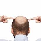 DETECTAR A TIEMPO LA ALOPECIA, con Helga Rivera