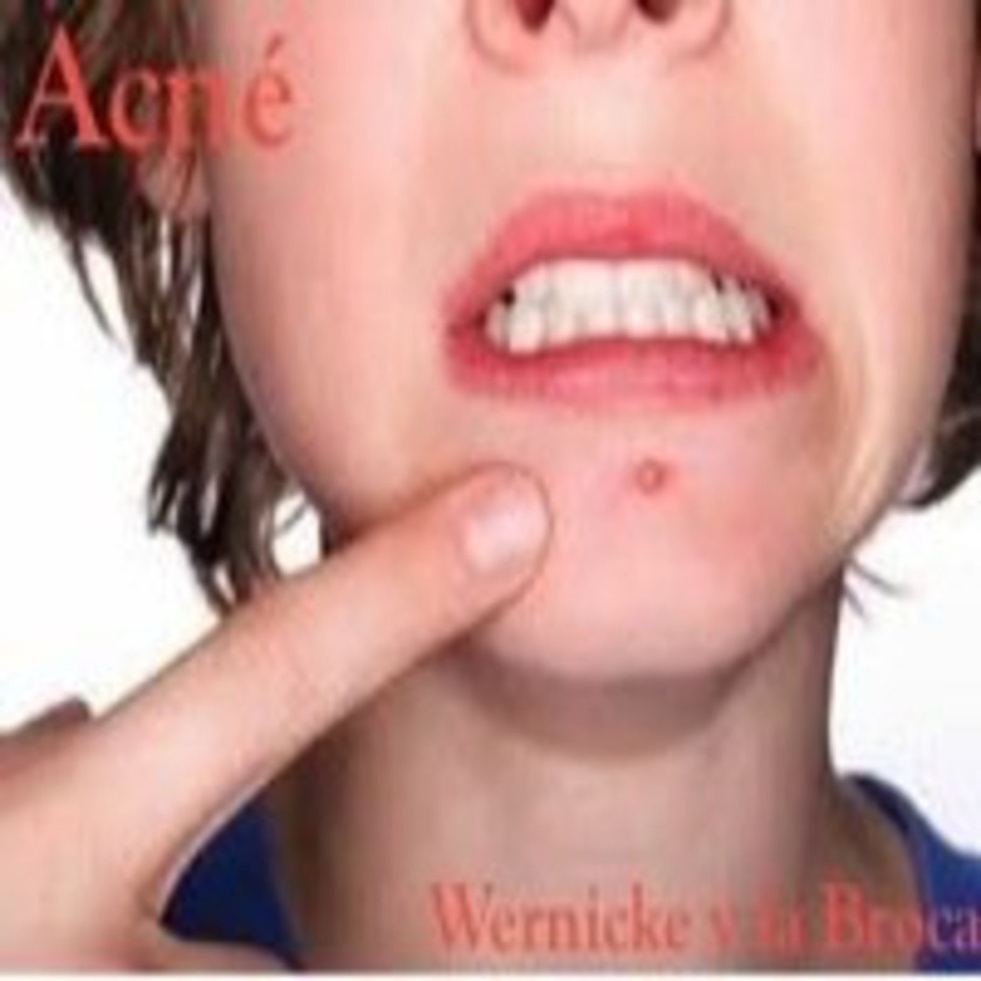 Acné en Wernicke y la Broca episode artwork