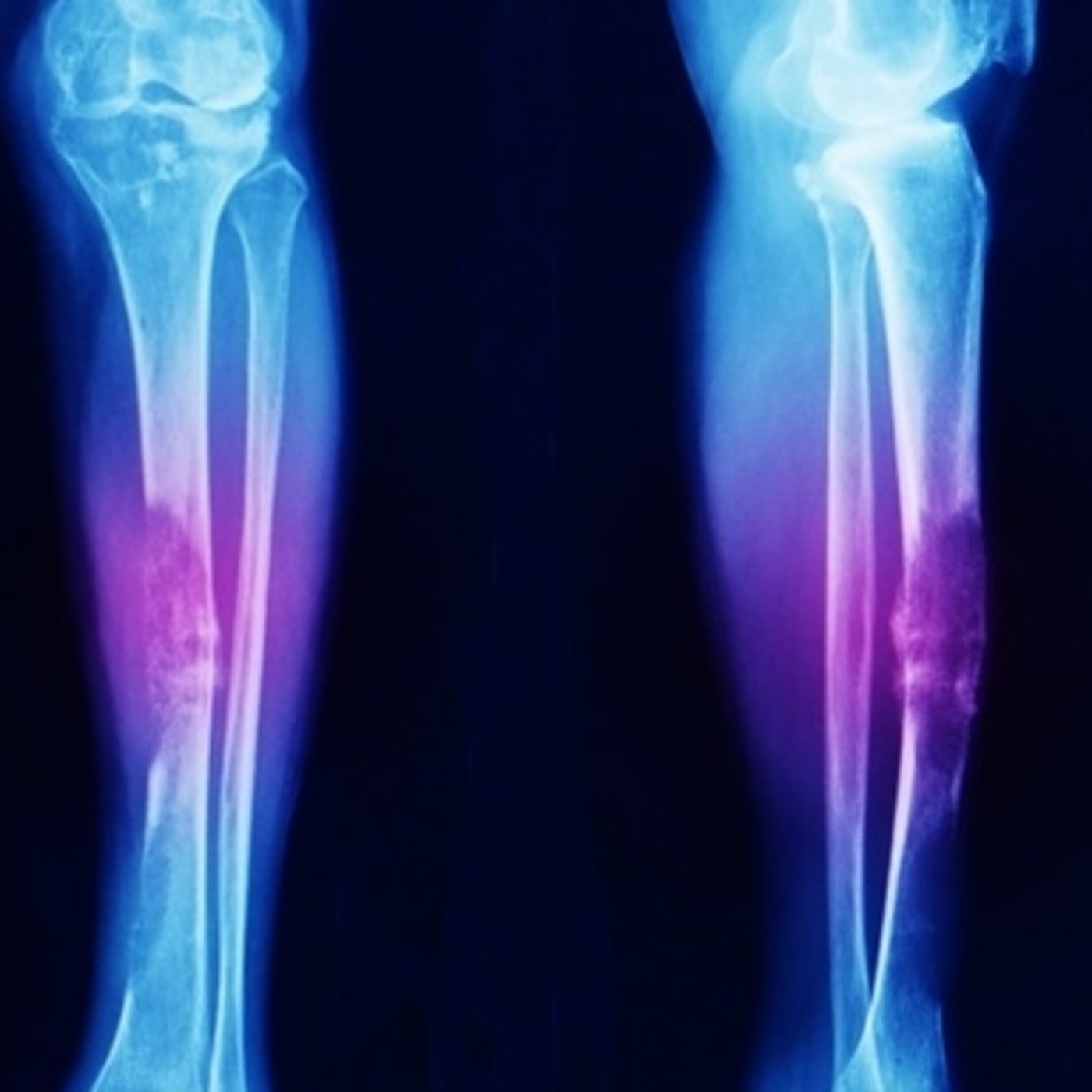 Células troncales y cáncer