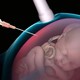 El aborto y las leyes