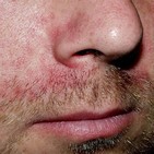 CÓMO TRATAR LA DERMATITIS SEBORREICA, con Helga Rivera