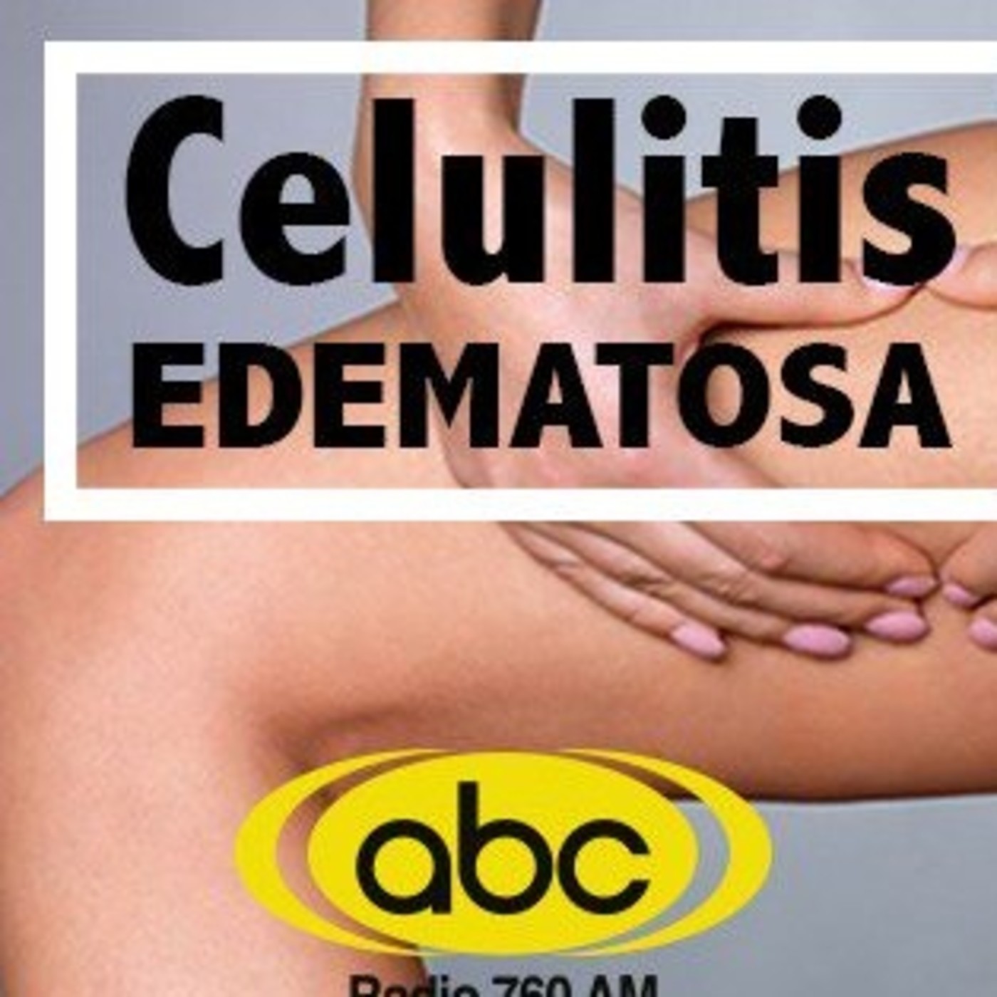 El Angel de tu Salud- CELULITIS EDEMATOSA