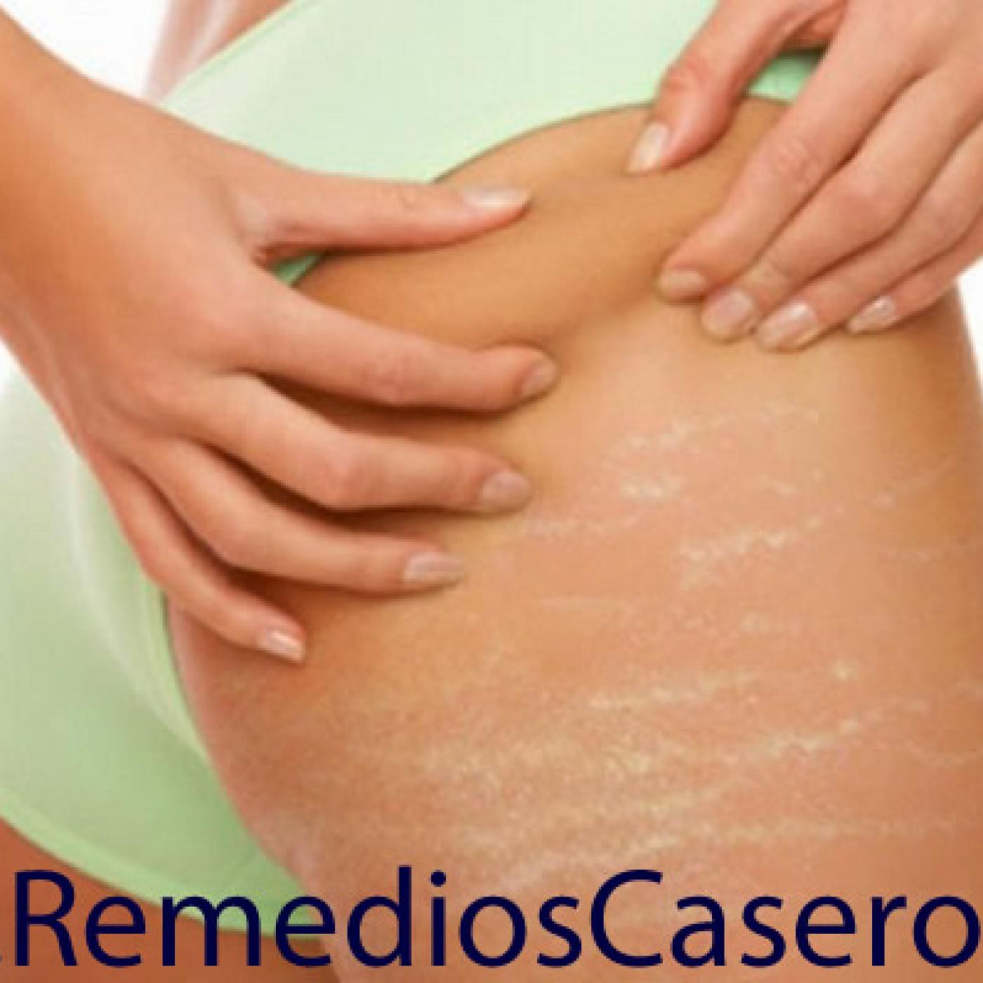 Remedios Caseros