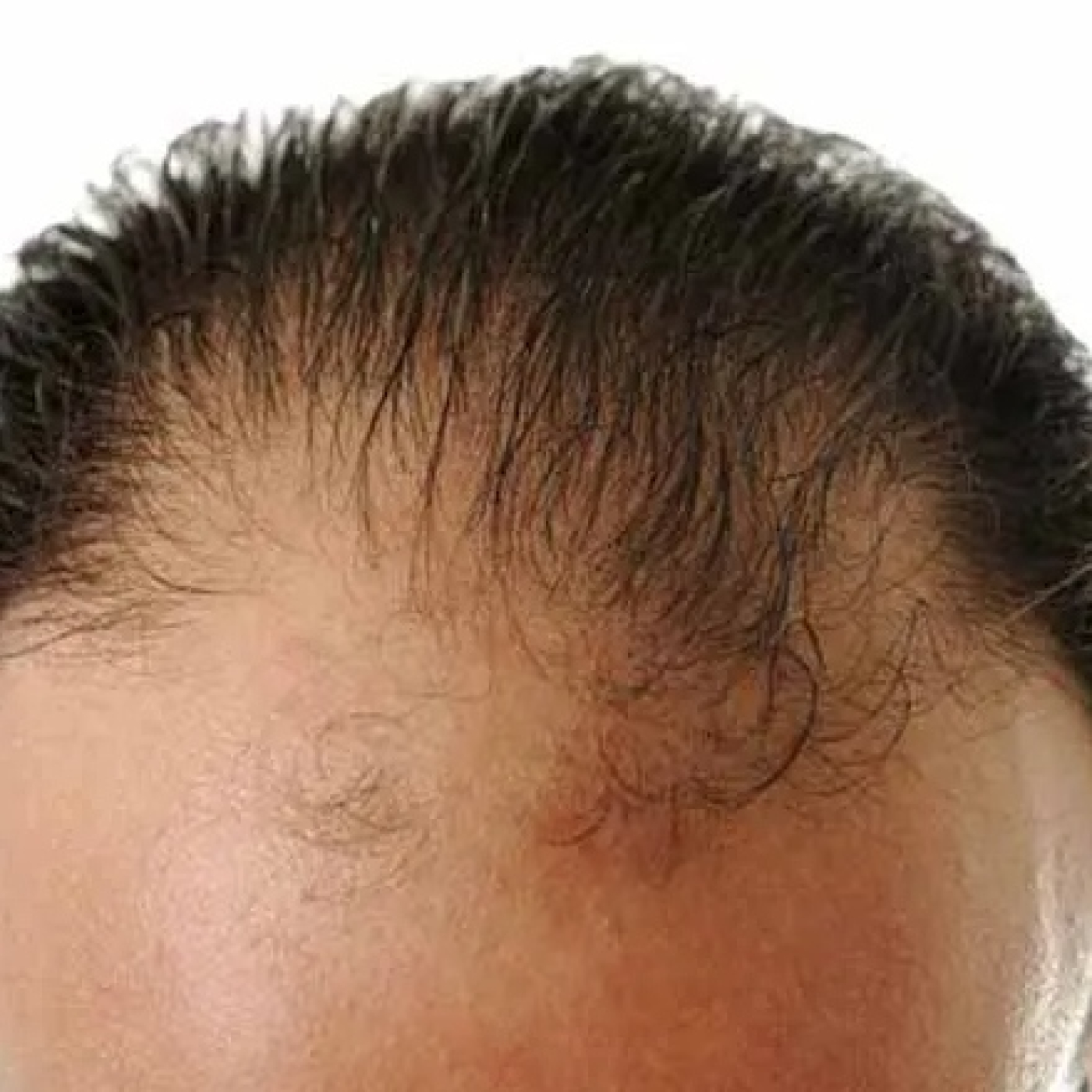 Conflictos emocionales que causan ALOPECIA episode artwork