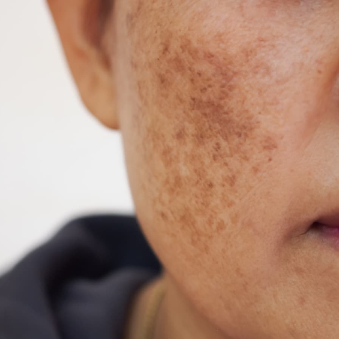 AVANCES EN EL TRATAMIENTO DEL MELASMA, con Dra. Helga Rivera