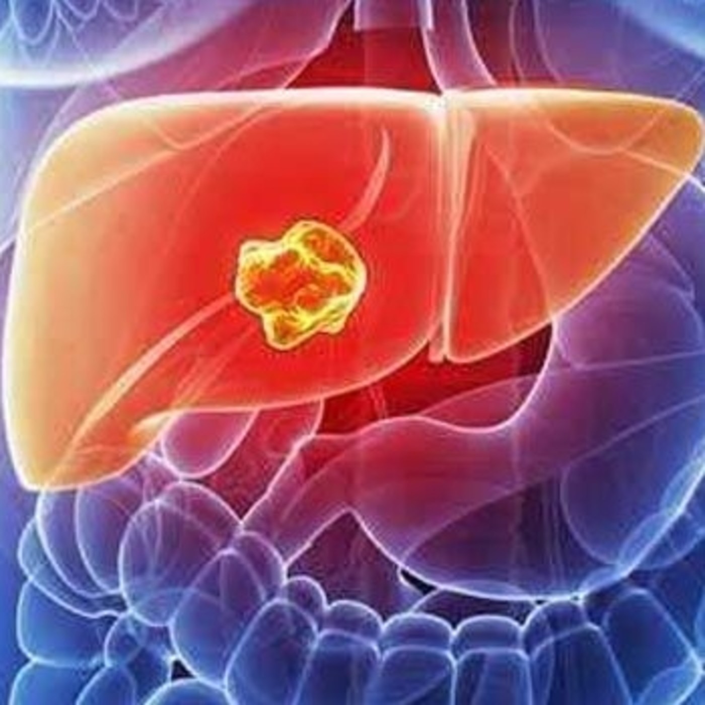 Células troncales y cáncer