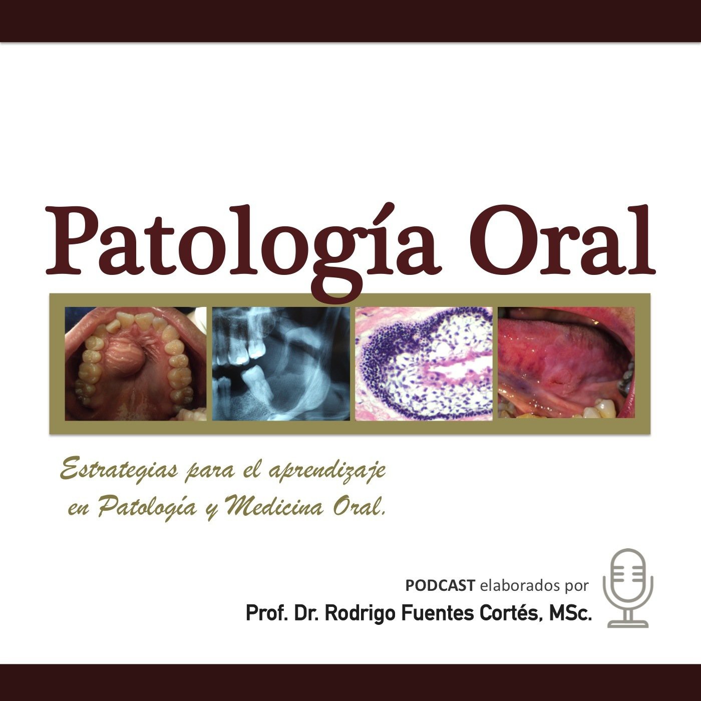 PDA 2019: Pericoronaritis. Clínica, estudio y manejo.